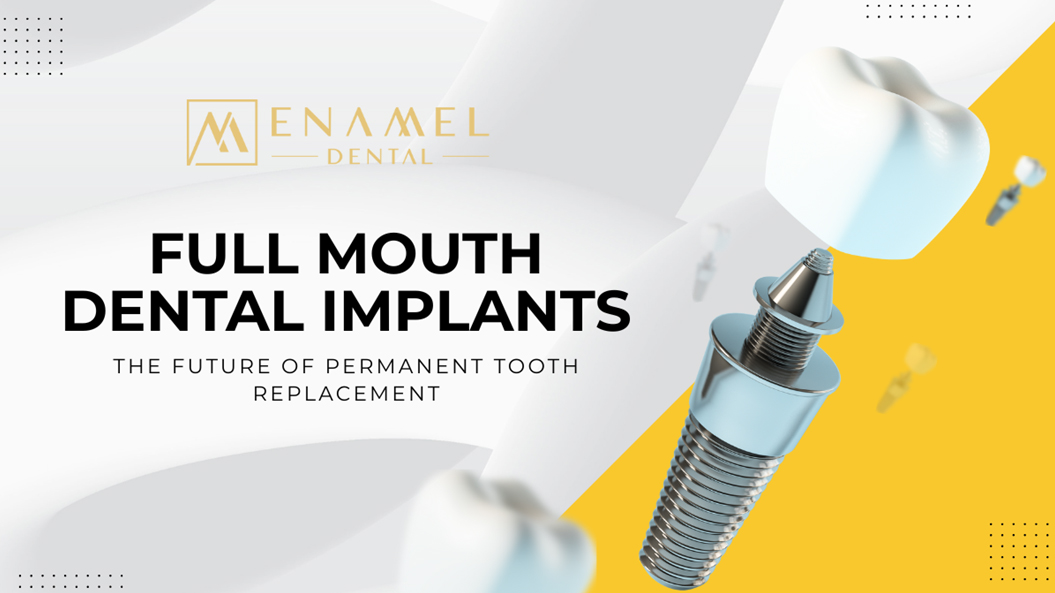Why Full Mouth Dental Implants Are the Future of Permanent Tooth Replacement